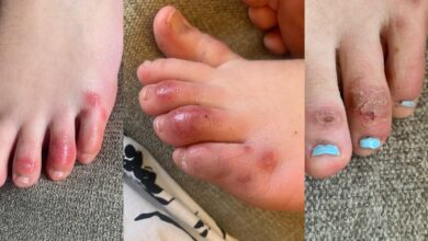 Range of COVID-19 Skin Signs Linked to Disease Severity 1 1690 covid toes