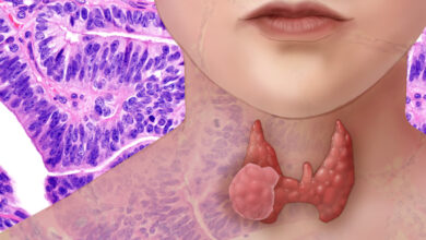 New Thyroid Cancer Test is Faster and More Accurate 10 A new preoperative test for thyroid cancer is faster and about two-thirds more accurate than the diagnostic tests doctors use today, report researchers.