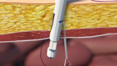 Effective, Simple and Fast Way of Laparoscopic Port Closure for Trocar Site Hernia Prevention 7 208 flat aelc emca carter thomason 2 port closure cover photo site