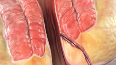Treatment of Anal Fistula Tract with Laser Ablation 7 775 flat aelc emca zmed lazer fistula treatment cover photo site