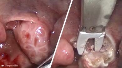 665 flat aelc emca bizact tonsillectomy cover photo e2