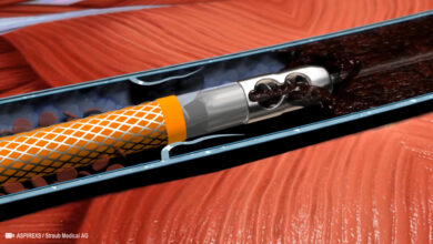 Mechanical Thrombectomy for Acute Occlusions of Pulmonary Arteries 7 702 flat aelc emca ASPIREXS by Straub Medical AG cover photo e2