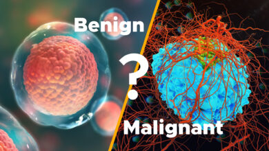 What is the Difference Between Tumor and a Cancer? 4 What is the Difference Between Tumor and a Cancer?