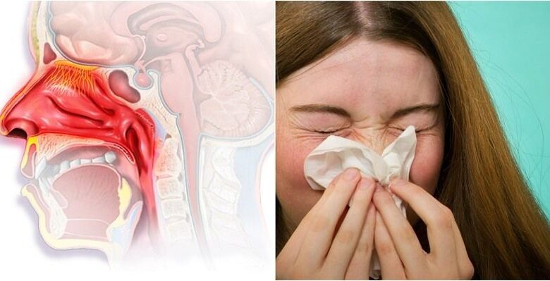 Blocked Nose All the Time What is Nasal Congestion