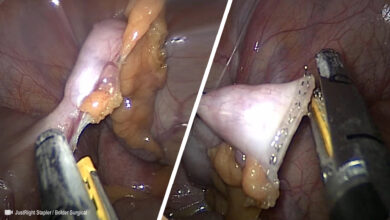This Pediatric Stapler that Can Fit into Tight Spaces and Reducing Port Size from 12mm to 5mm