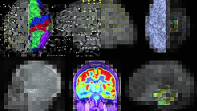 Early Warning of Seizures Can Be Groundbreaking for Epilepsy Patients