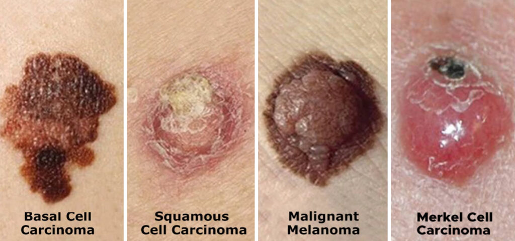 The Most Dangerous Form Of Skin Cancer Is