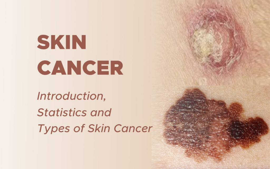 Skin Cancer: Introduction, Statistics and Types of Skin Cancer | SurgMedia