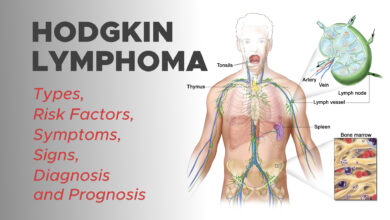 Hodgkin Lymphoma: Types, Risk Factors, Symptoms, Signs, Diagnosis and Prognosis 12 Hodgkin Lymphoma: Types, Risk Factors, Symptoms, Signs, Diagnosis and Prognosis