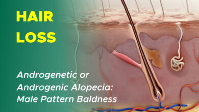 Male Pattern Hair Loss: Androgenetic Alopecia 17 Male Pattern Hair Loss: Androgenetic Alopecia Androgenic Alopecia Male Pattern Alopecia Male Pattern Baldness Pattern Baldness