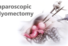 Laparoscopic Myomectomy