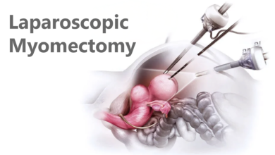Laparoscopic Myomectomy: Is it Better? 3 Laparoscopic Myomectomy